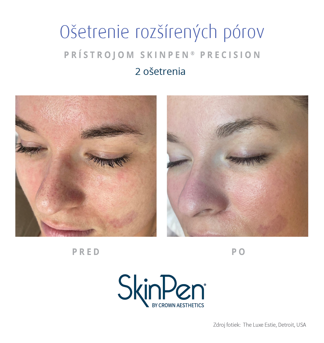 Zmenšenie rozšírených pórov Skinpen microneedlingom