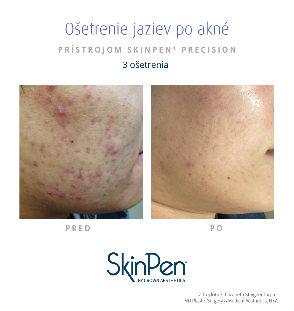 Ošetrenie jaziev po akné Skinpen microneedling