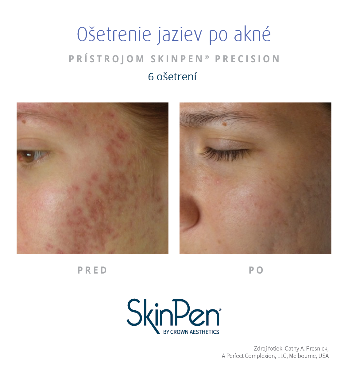 Ošetrenie jaziev po akné Skinpen microneedlingom