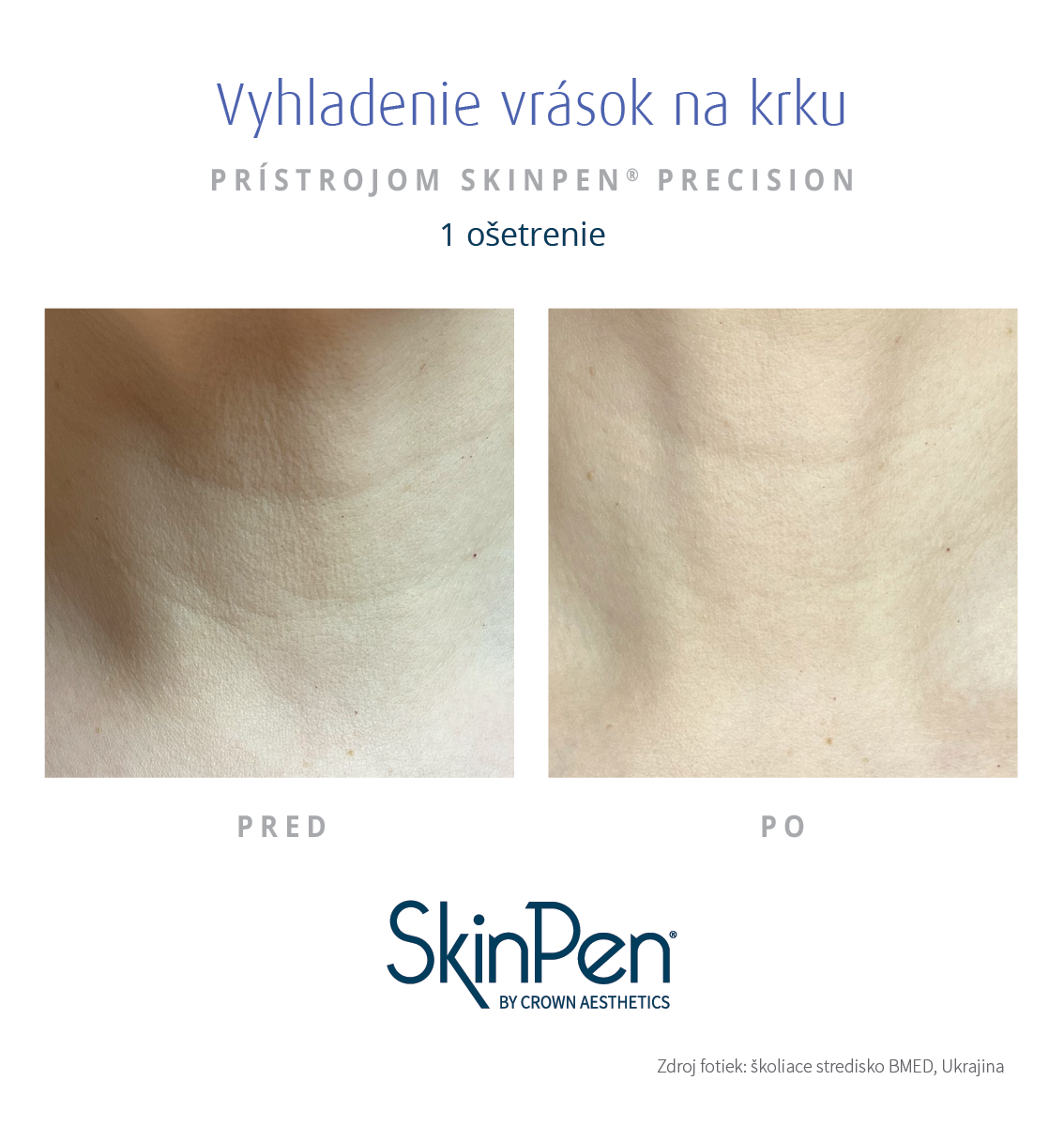 Skinpen zmenšenie vrások na krku